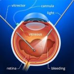 Separating Fact from Fiction: Central Serous Chorioretinopathy Treatment Myths You Should Stop Believing