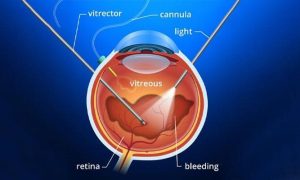 Separating Fact from Fiction: Central Serous Chorioretinopathy Treatment Myths You Should Stop Believing